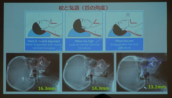 軽度の睡眠時無呼吸症は寝具で改善